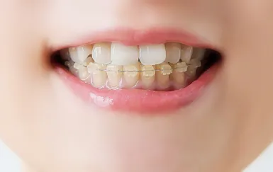 ワイヤー矯正（表側矯正）の画像