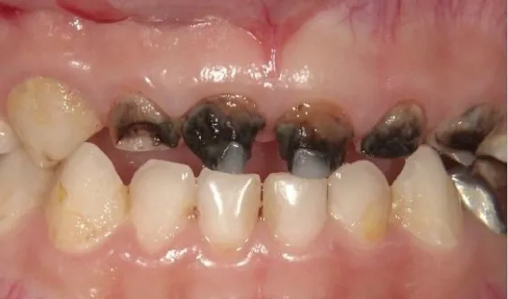 上の前歯が黒く虫歯になっている歯列