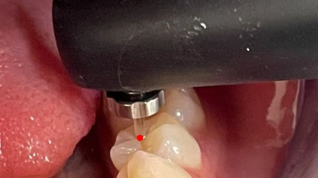 レーザー光を使ったむし歯診断機器（ダイアグノデント）を使用する様子