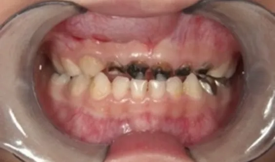 上の前歯が黒く虫歯になっている歯列