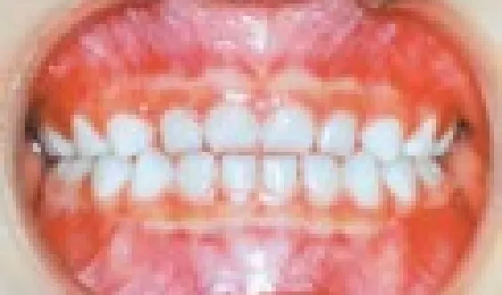 虫歯の無いきれいな白い乳歯列