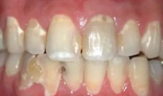 ところどころ虫歯になっている歯列