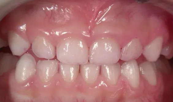 虫歯の無いきれいな白い乳歯列