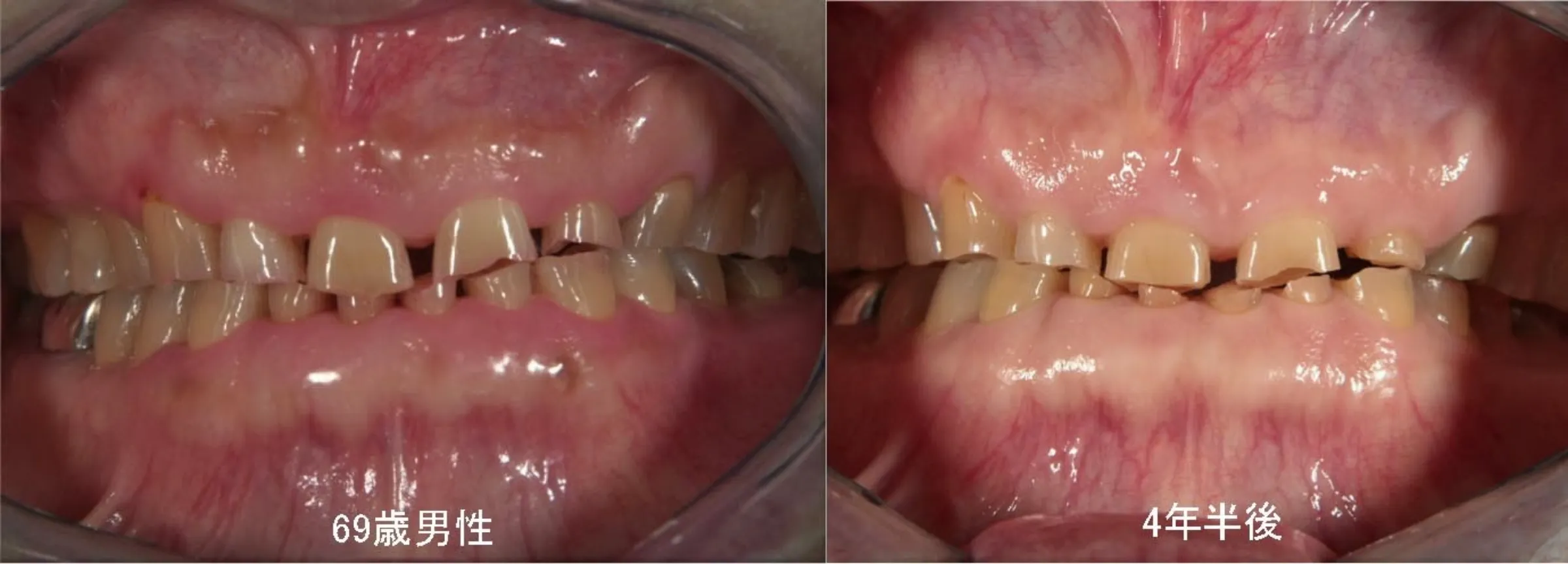 69歳男性が歯ぎしりによって4年半で歯がすり減った症例画像