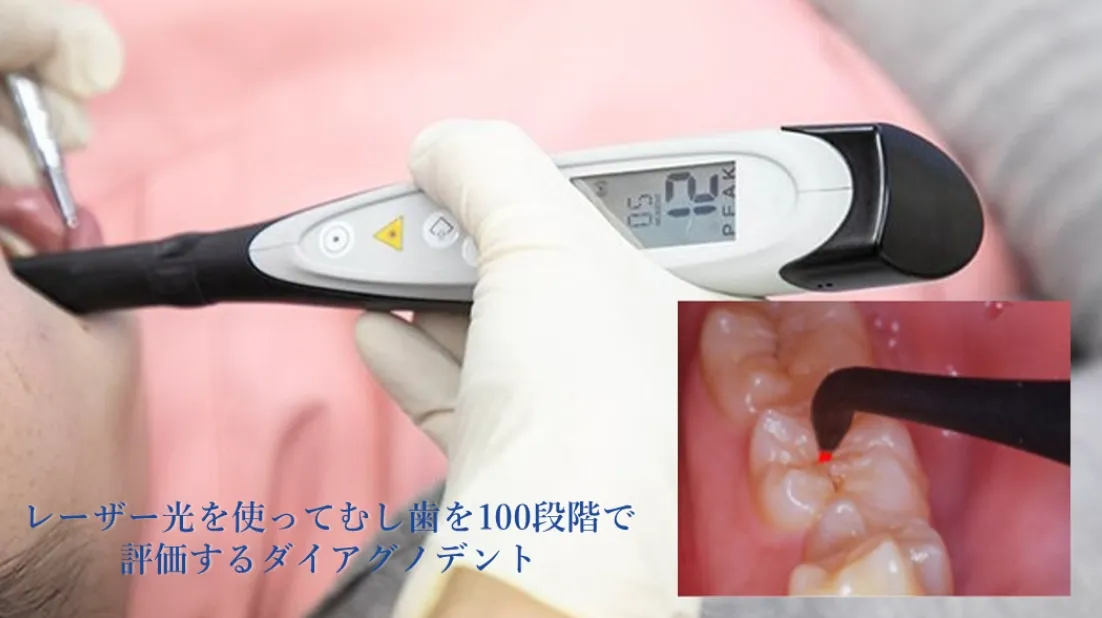 レーザー光を使って虫歯を100段階で評価するダイアグノデント