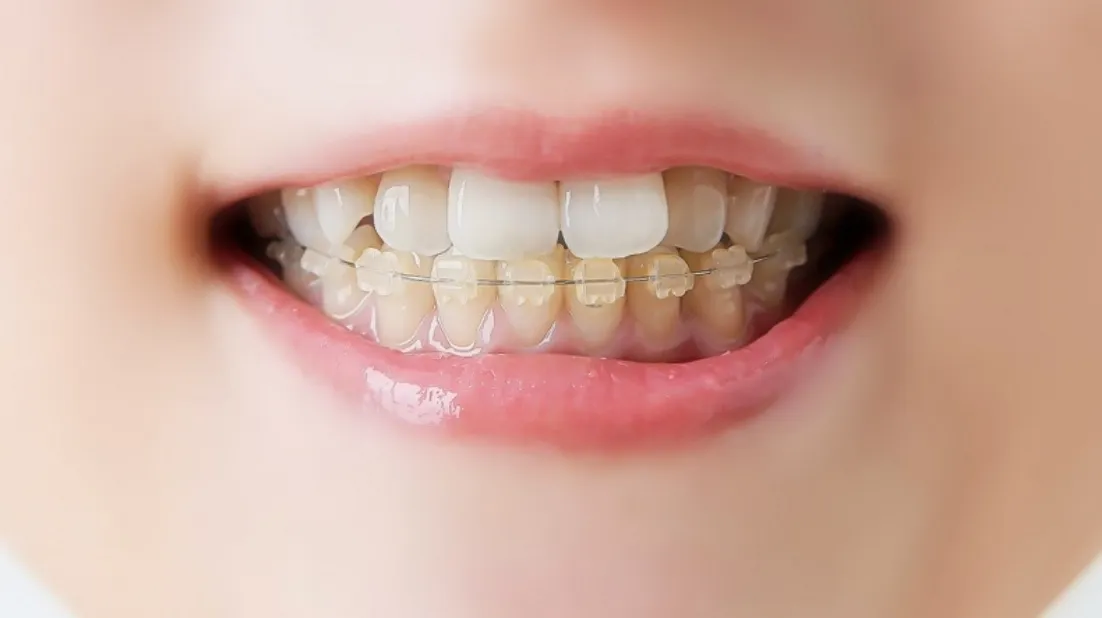 矯正器具を装着した口元