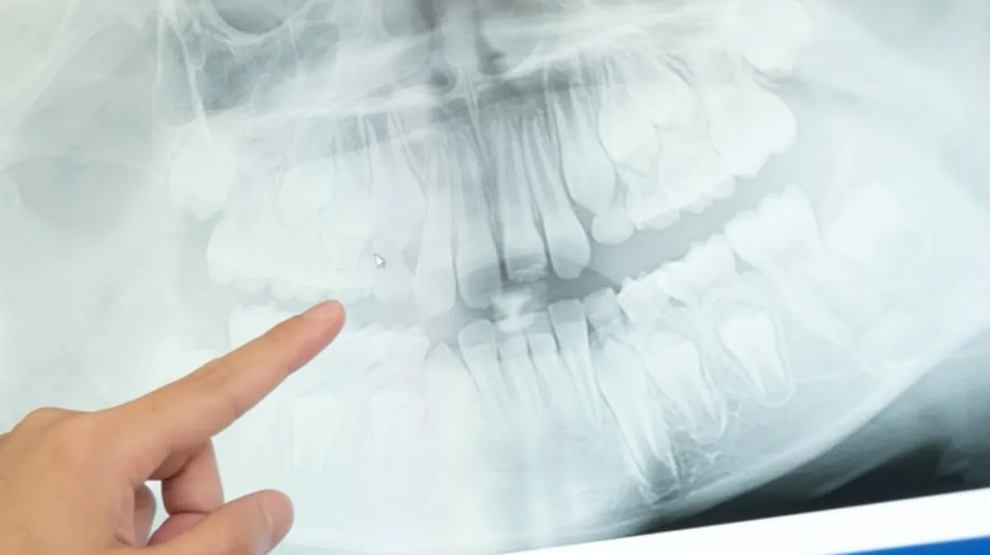 歯のレントゲン画像を指差す様子